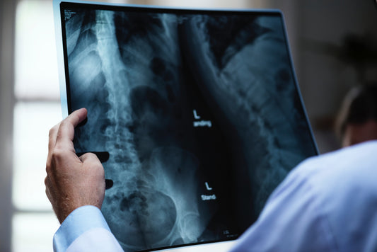 Osteoporosis: How, why, when, everything!