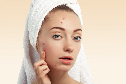 Is Salicylic Acid Good for Skin Acne?