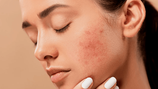 PCOS and Acne